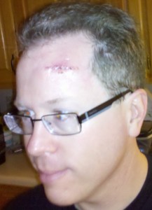 incision